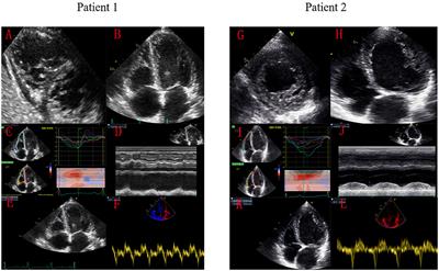 Influence of Right Ventricular Dysfunction on Outcomes of Left Ventricular Non-compaction Cardiomyopathy